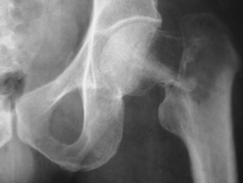 Hip Fractures: The bad, the ugly and the worse